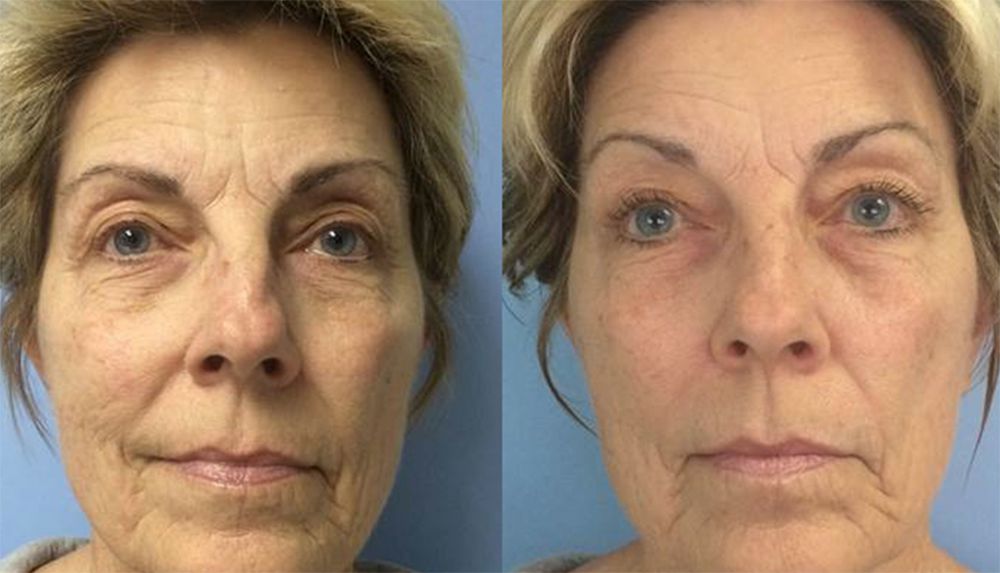 anti-aging treatment sebastopol